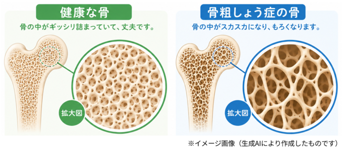 骨粗のイメージ図